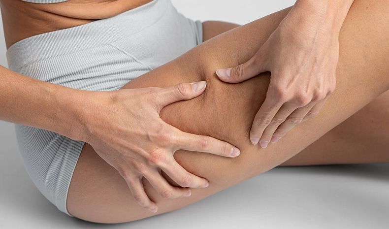 ¡Dile adiós a la celulitis y da la bienvenida al verano con WOW Shape!